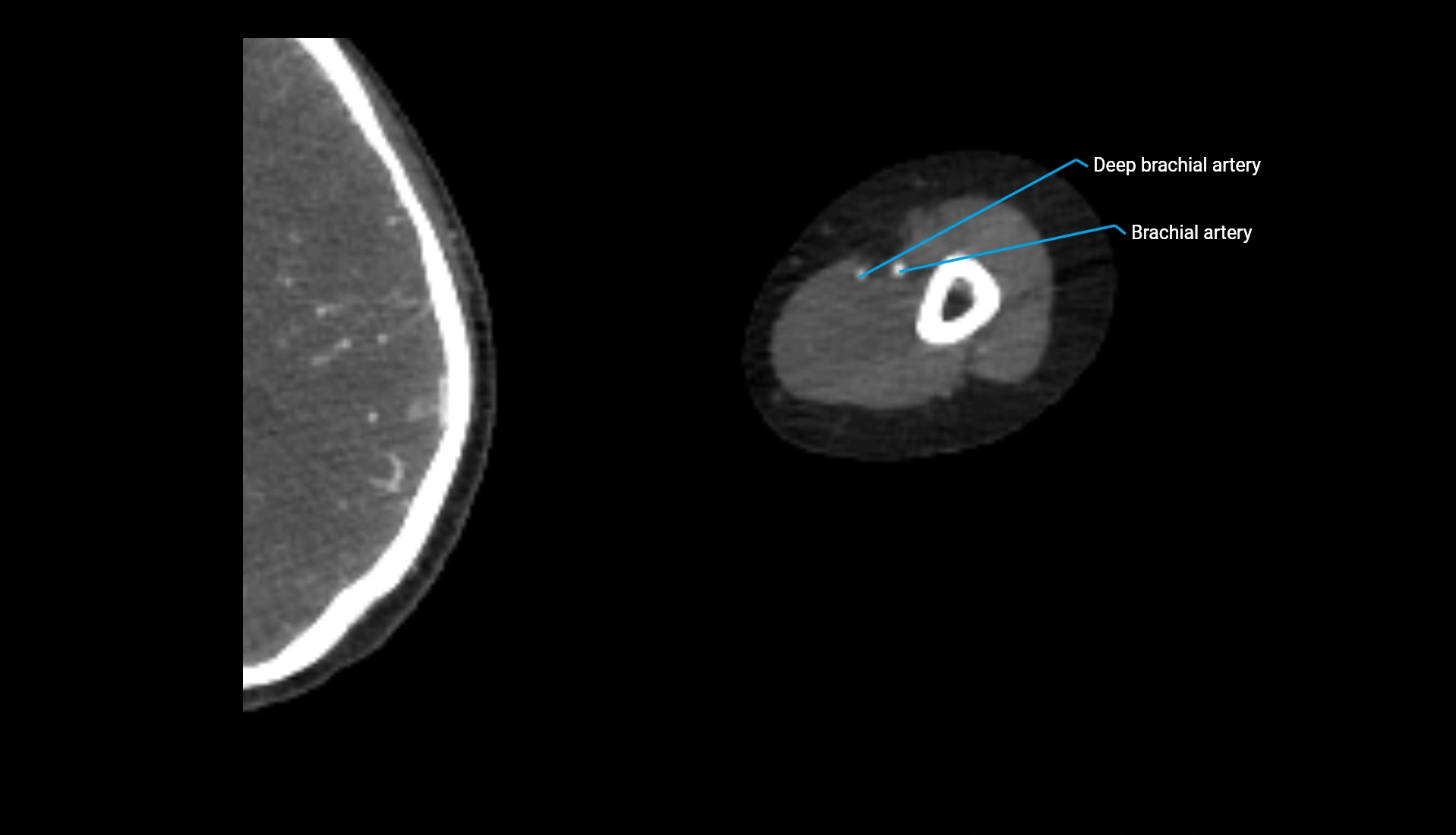 CTA upper limb axial cross sectional anatomy labelled image 238 (2).webp